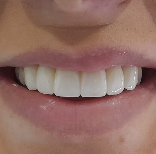 dentin4